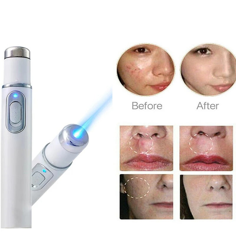 Acne Laser Removal Pen with Blue Light